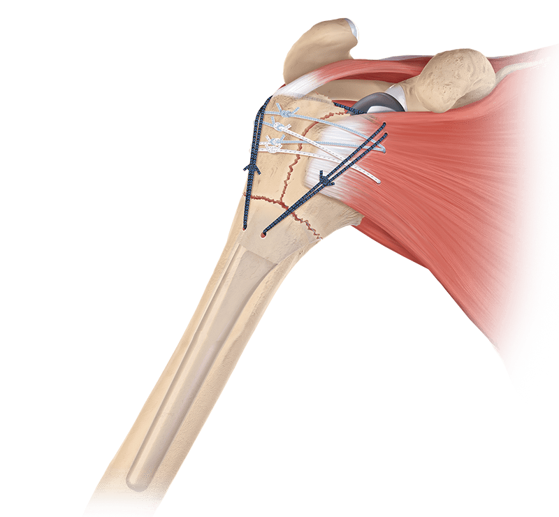 Arthrex - FxBridge™ Tuberosity Repair System